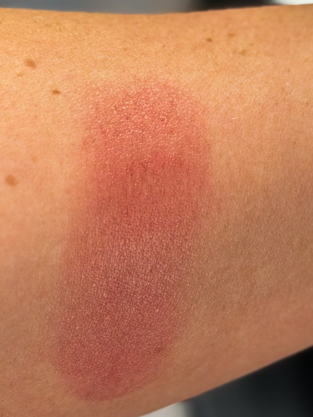 Close-up of a person's arm with a red mark, wearing a green sleeve and gold bracelet.