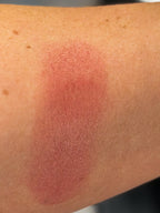 Close-up of a person's arm with a red mark, wearing a green sleeve and gold bracelet.